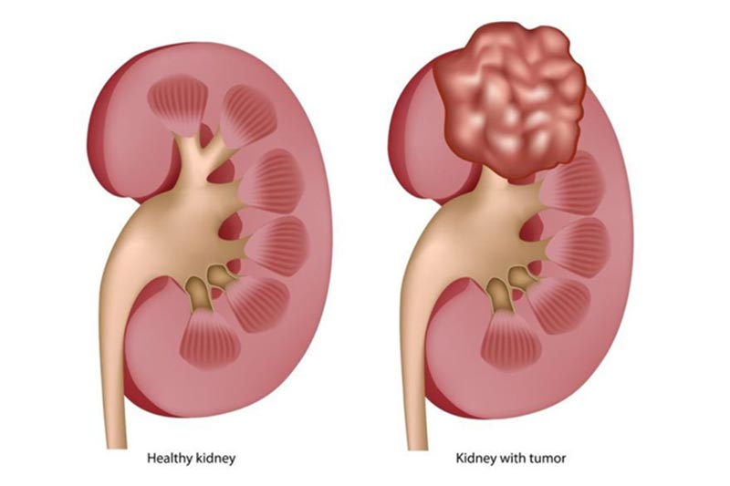 Mass in Kidney: Is it a Cancer?